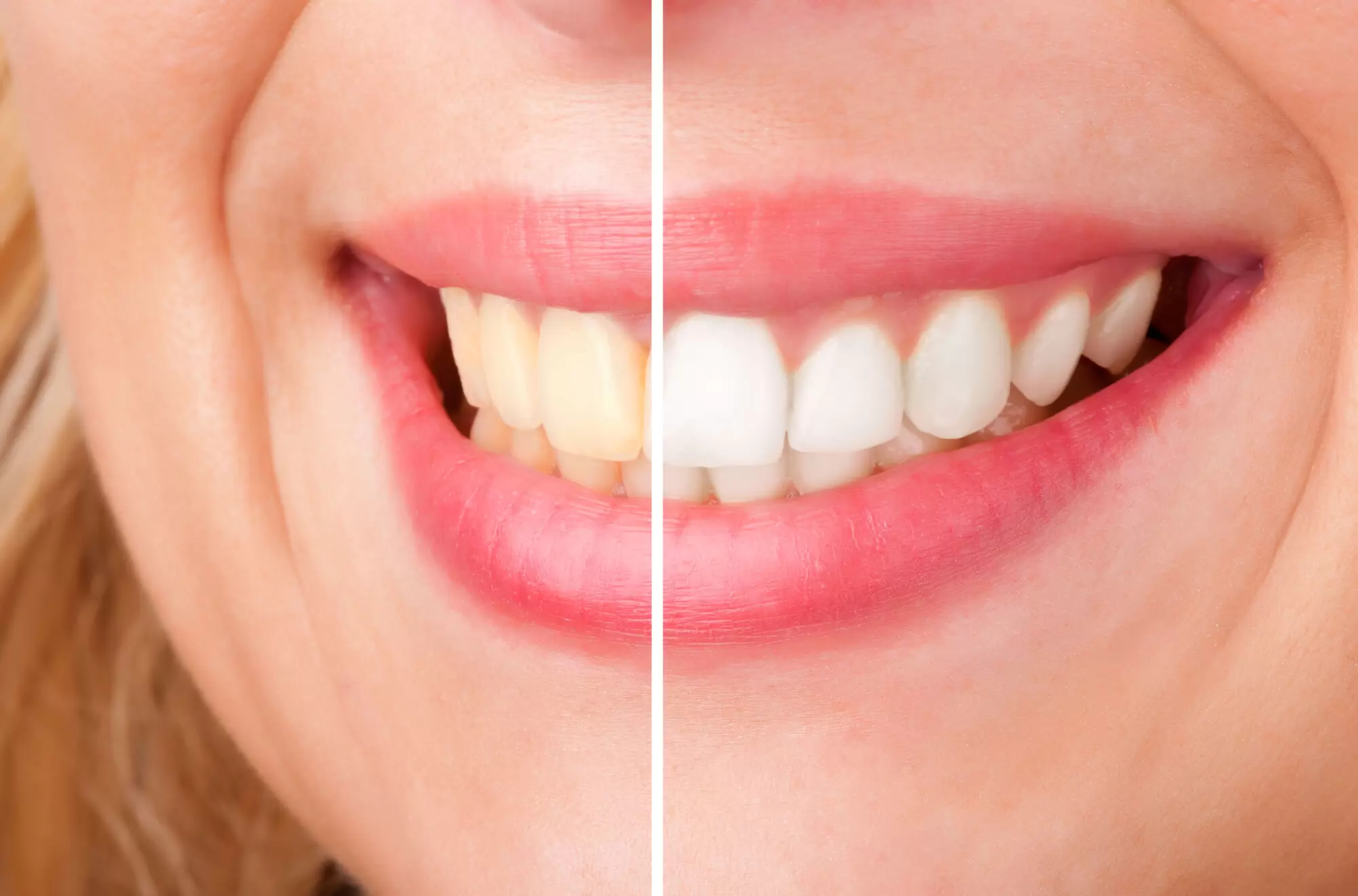 comparison of dull and white teeth dental implants in Miami