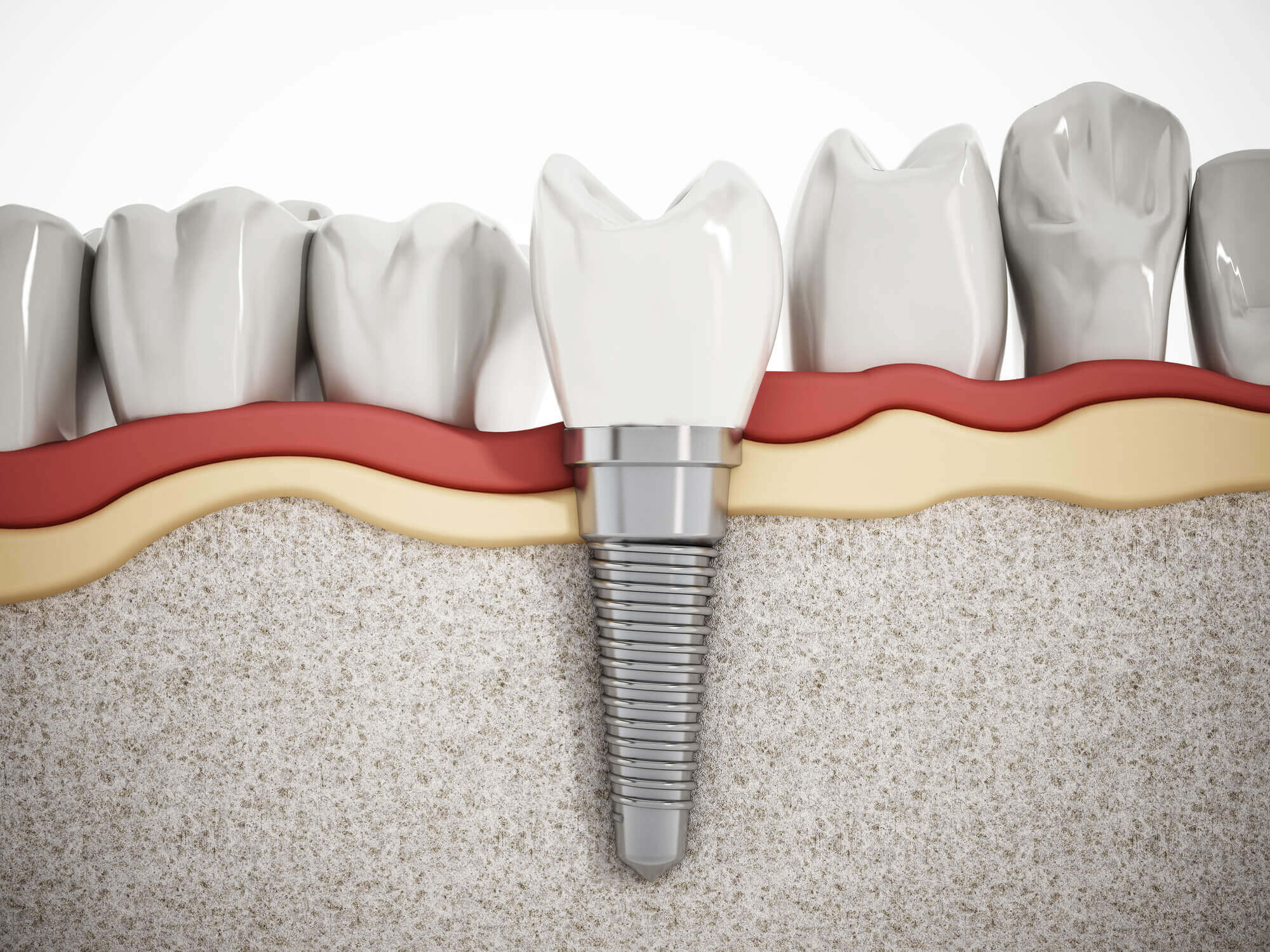 dental implants in Miami illustration