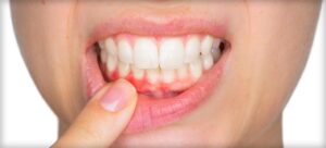 Person points to inflamed gums, revealing bright white teeth and red, swollen gums.
